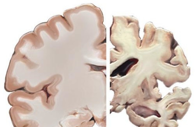A healthy brain compared to a brain suffering from Alzheimer
